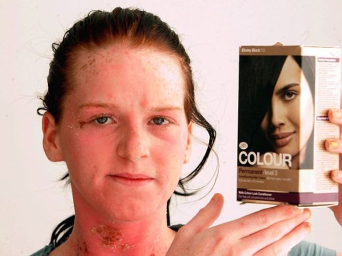 Аллергия на краску для волос (жесть)