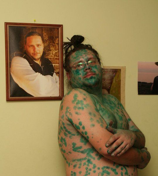 Эх ветрянка-ветряночка)