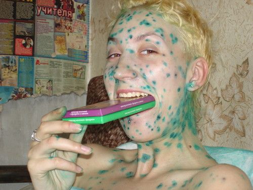 Эх ветрянка-ветряночка)