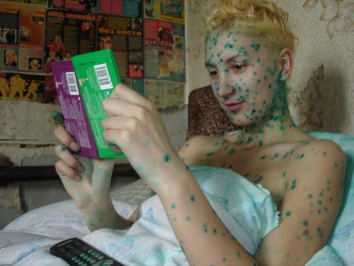 Эх ветрянка-ветряночка)