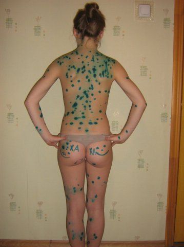 Эх ветрянка-ветряночка)