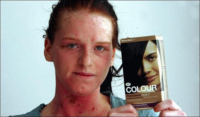 Аллергия на краску для волос (жесть)